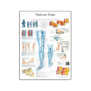 Affiche plastifiée sur les varices