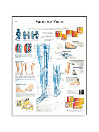 Affiche plastifiée sur les varices