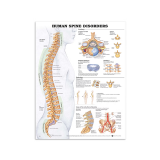 Affiche sur les maladies de la colonne vertébrale (anglais)