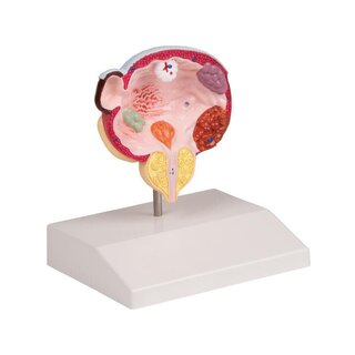 Maladies de la vessie et de la prostate