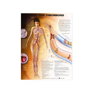 Thrombose veineuse profonde (TVP) - affiche