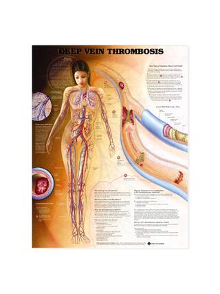 Thrombose veineuse profonde (TVP) - affiche
