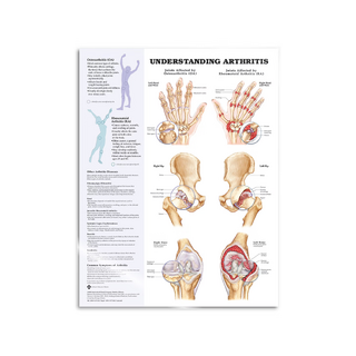 Arthrite laminée en anglais