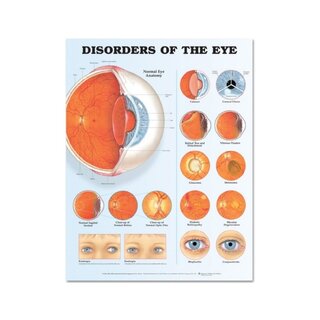 Affiche plastifiée sur les maladies oculaires (troubles oculaires)