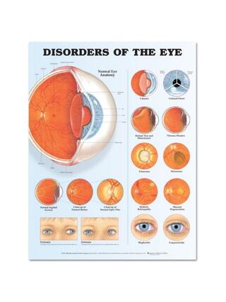 Affiche plastifiée sur les maladies oculaires (troubles oculaires)