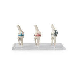 Modèle d'implant de genou