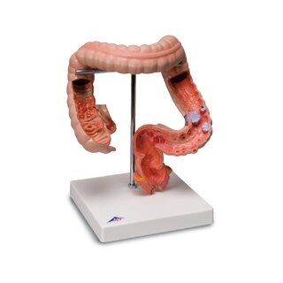 Modèle détaillé du gros intestin montrant plusieurs maladies