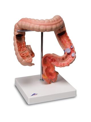 Modèle détaillé du gros intestin montrant plusieurs maladies