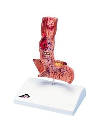 Modèle de l'oesophage avec des conditions pathologiques