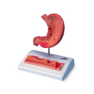 Mini modèle de l'estomac avec un ulcère à l'estomac