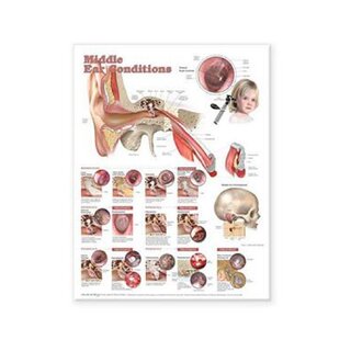 Affiche plastifiée sur les maladies de l'oreille moyenne (anglais)